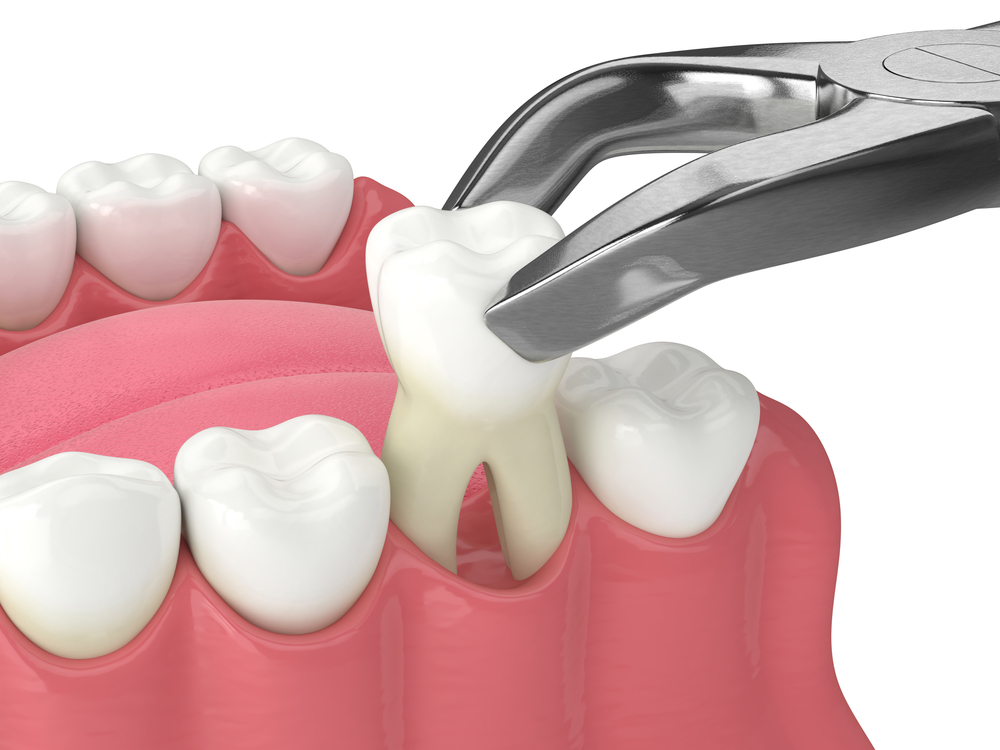 Tooth Extractions